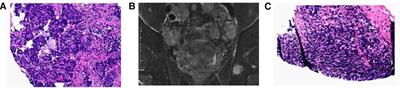 Cervical lymphadenopathy as initial presentation of metastatic prostate cancer: A retrospective study of five cases and literature review